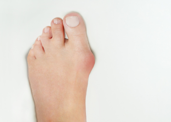Bunion on Foot