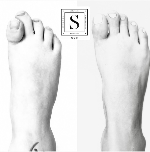 Bunion Surgery 2