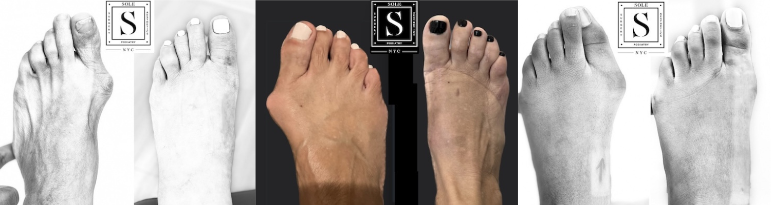 Lapiplasty 3D Bunion Correction- Client Results
