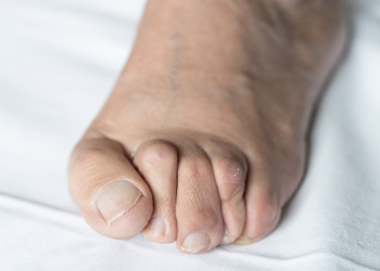 Hammer toe needing corrective measures