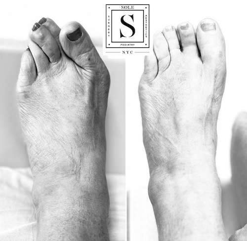 Bunion Surgery 1