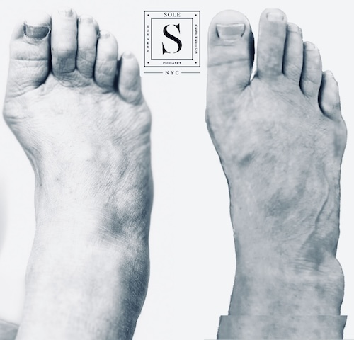 Bunion Surgery 3