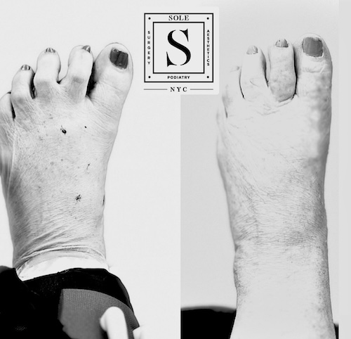 Bunion Surgery 4