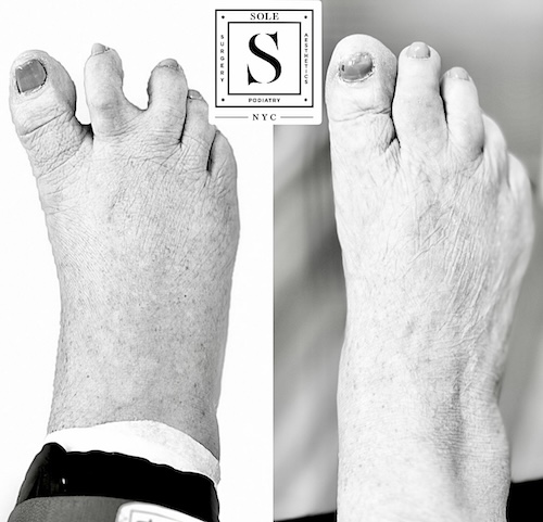 Bunion Surgery 5