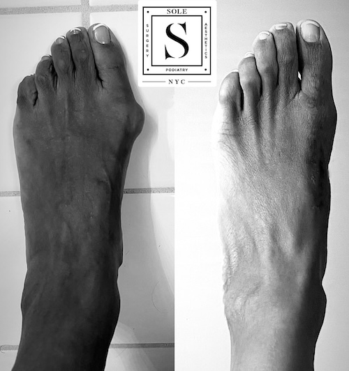 Bunion Surgery 6