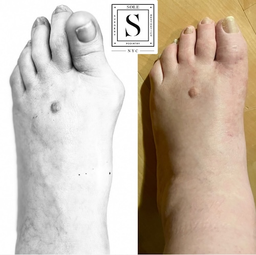 Bunion Surgery 7