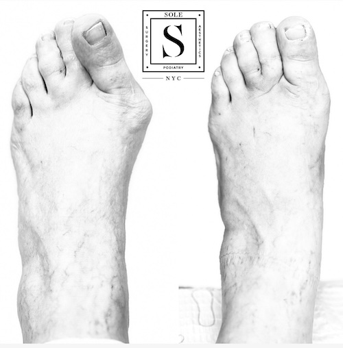 Bunion Surgery 7