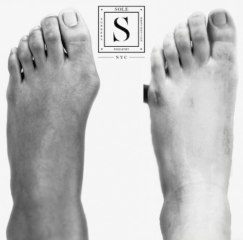 Bunion Surgery 6