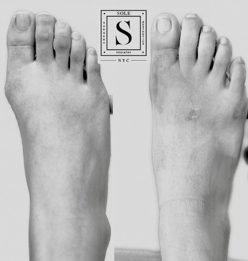 Bunion Surgery 8