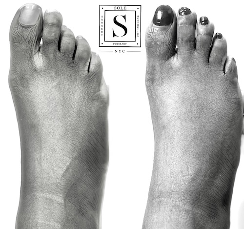Bunion Surgery 9