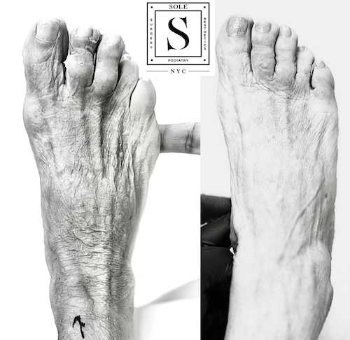 Bunion Surgery 10