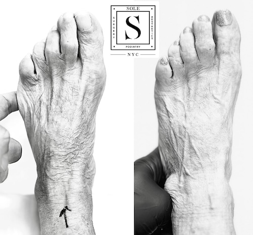 Bunion Surgery 11
