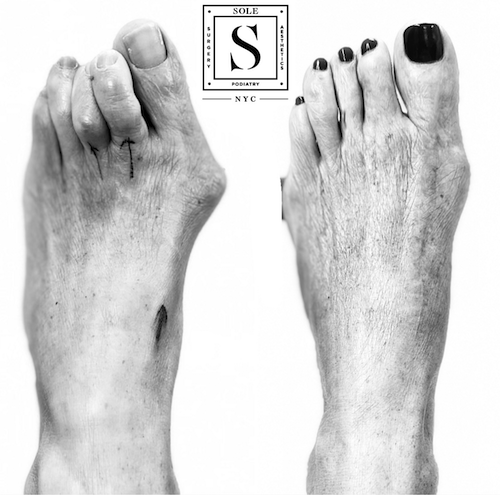 Bunion Surgery 12