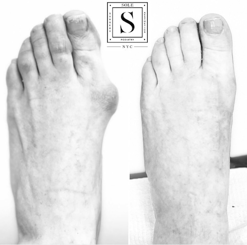 Bunion Surgery 12