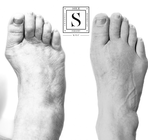 Bunion Surgery 13