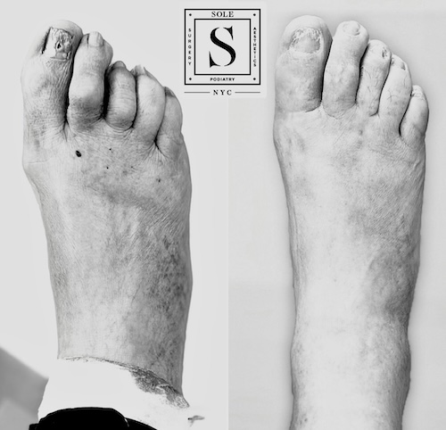 Bunion Surgery 14
