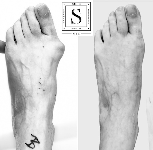 Bunion Surgery 15