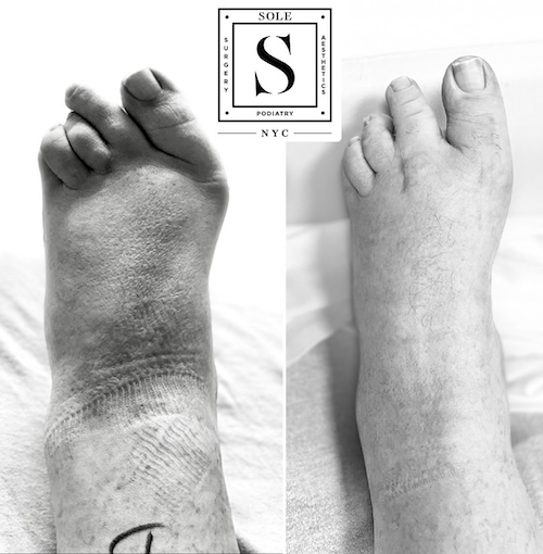 Bunion Surgery 16