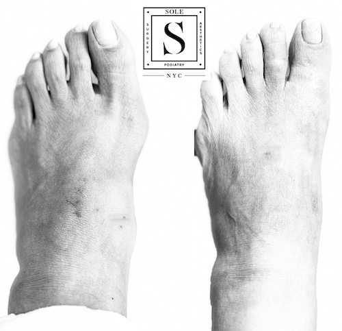 Bunion Surgery 17