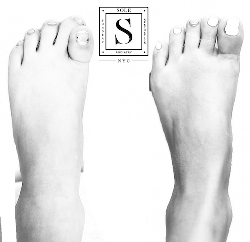 Bunion Surgery 18