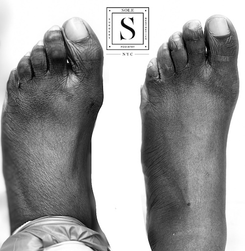 Bunion Surgery 19