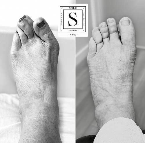 Bunion Surgery 20