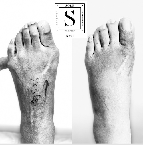 Bunion Surgery 21