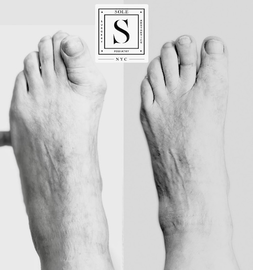 Bunion Surgery 22