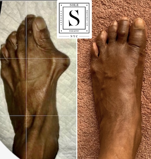 Bunion Surgery 23