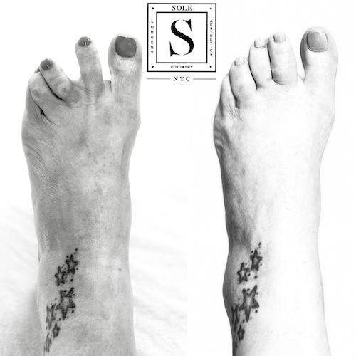 Bunion Surgery 24