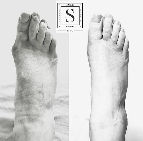 Bunion Surgery 25