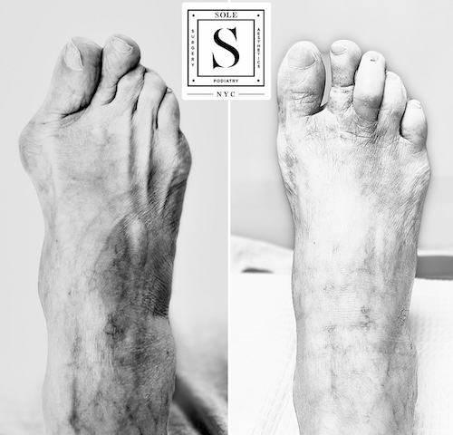 Bunion Surgery 26