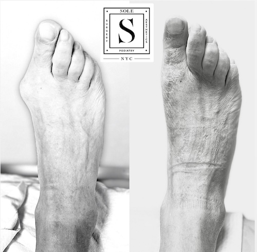 Bunion Surgery 27