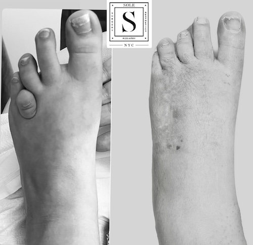 Bunion Surgery 28