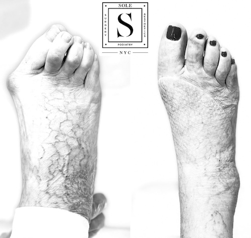 Bunion Surgery 29