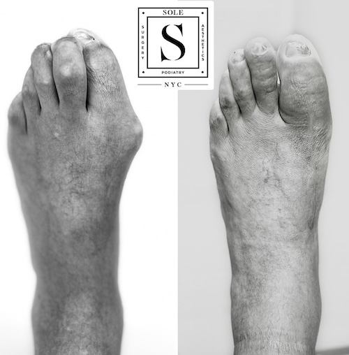 Bunion Surgery 30