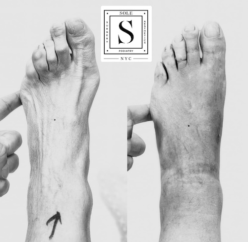 Bunion Surgery 31