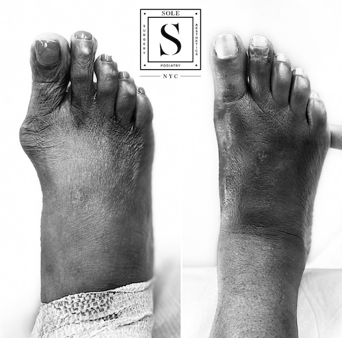 Bunion Surgery 32