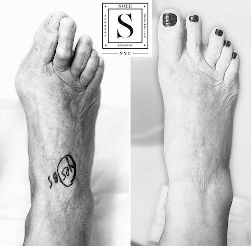 Bunion Surgery 35