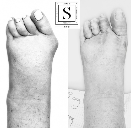 Bunion Surgery 35