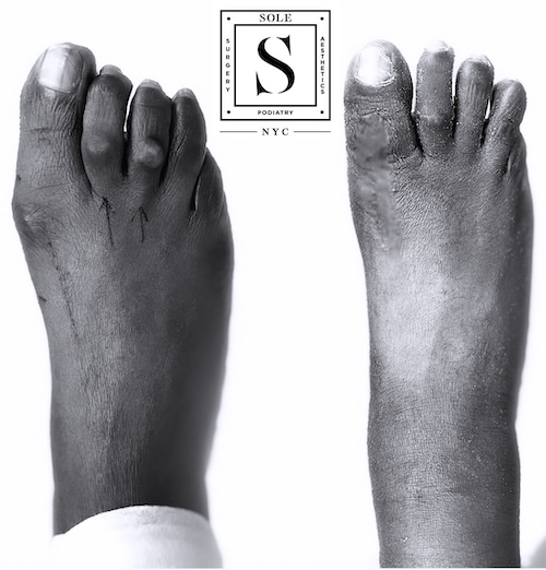 Bunion Surgery 36