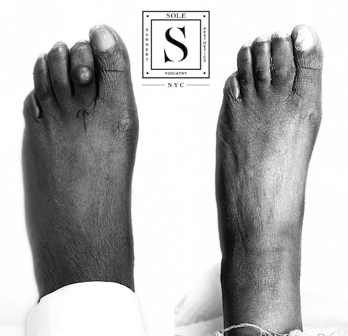 Bunion Surgery 36