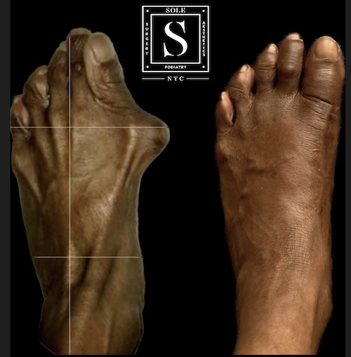 Bunion Surgery 38