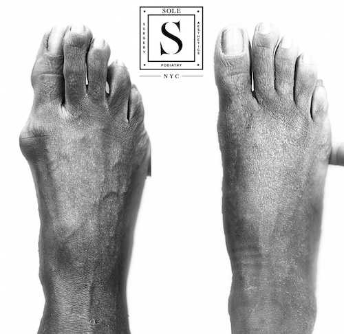 Bunion Surgery 39