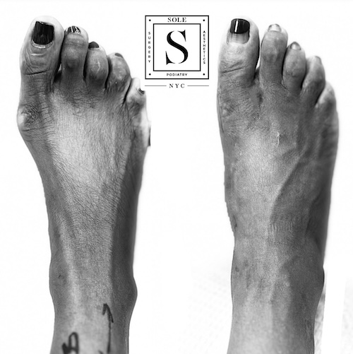 Bunion Surgery 40