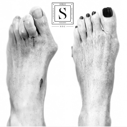Bunion Surgery 41