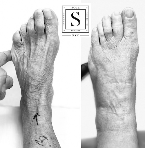 Bunion Surgery 42