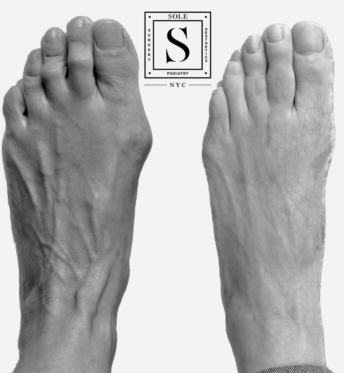 Bunion Surgery 46