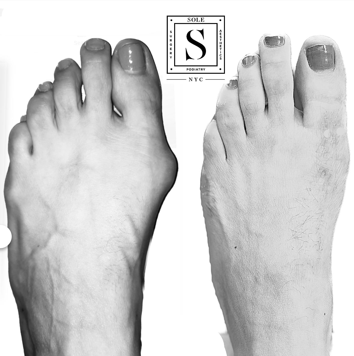 Bunion Surgery 46