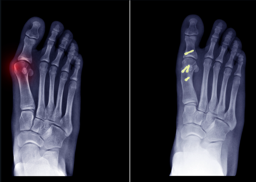 X-ray showing a bunion in the foot